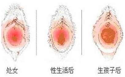 重慶軍科私密整形醫(yī)院——什么是陰道緊縮術(shù)?