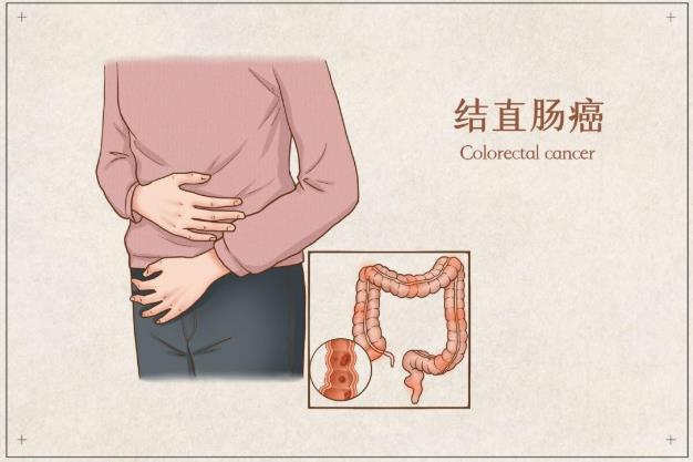 泰萊生物助力結(jié)直腸癌篩查診斷提高準(zhǔn)確性
