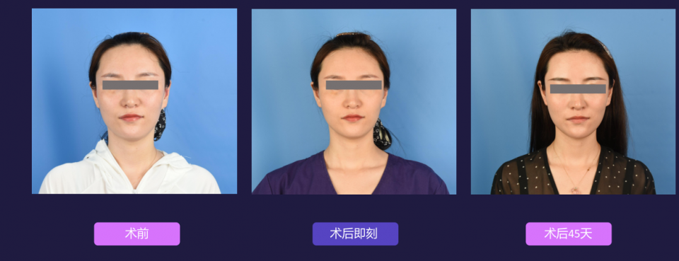 寧波藝星整形醫院:7D黃金超聲炮,深層抗衰,一次抵三次熱瑪吉!