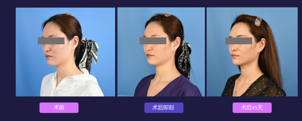 寧波藝星整形醫院:7D黃金超聲炮,深層抗衰,一次抵三次熱瑪吉!