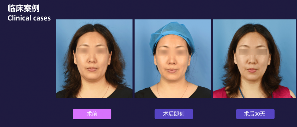寧波藝星整形醫院:7D黃金超聲炮,深層抗衰,一次抵三次熱瑪吉!