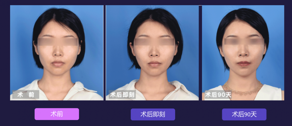 寧波藝星整形醫院:7D黃金超聲炮,深層抗衰,一次抵三次熱瑪吉!