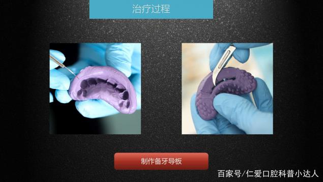 武漢仁愛口腔 數(shù)字化即刻美學(xué)貼面案例分享