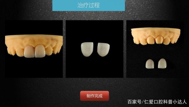 武漢仁愛口腔 數(shù)字化即刻美學(xué)貼面案例分享