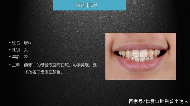 武漢仁愛口腔 數(shù)字化即刻美學(xué)貼面案例分享