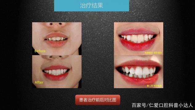 武漢仁愛口腔 數(shù)字化即刻美學(xué)貼面案例分享