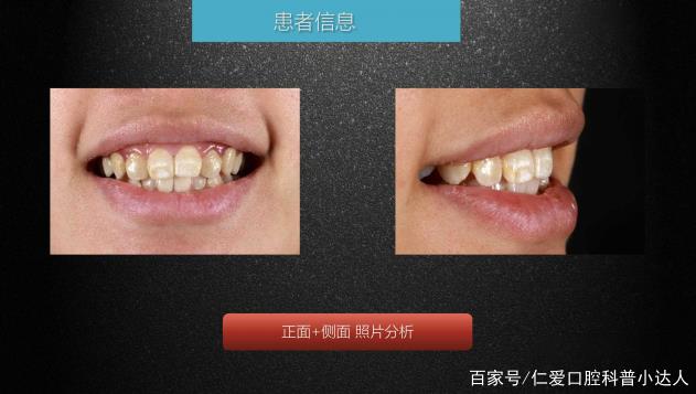 武漢仁愛口腔 數(shù)字化即刻美學(xué)貼面案例分享