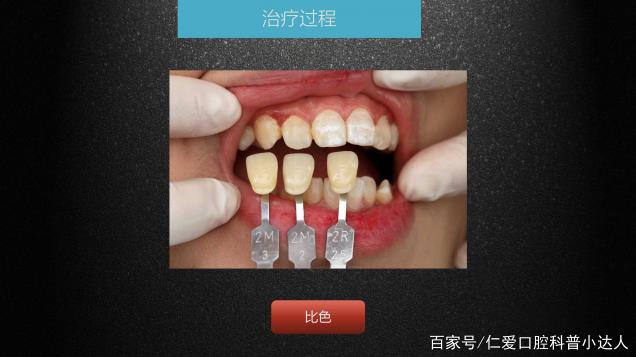 武漢仁愛口腔 數(shù)字化即刻美學(xué)貼面案例分享