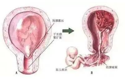安太醫院陳鳳林 帶您了解晚期流產