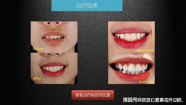 武漢仁愛口腔 數字化即刻美學貼面案例分享