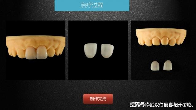 武漢仁愛口腔 數字化即刻美學貼面案例分享