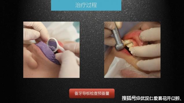 武漢仁愛口腔 數字化即刻美學貼面案例分享
