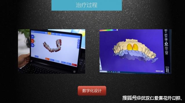 武漢仁愛口腔 數字化即刻美學貼面案例分享