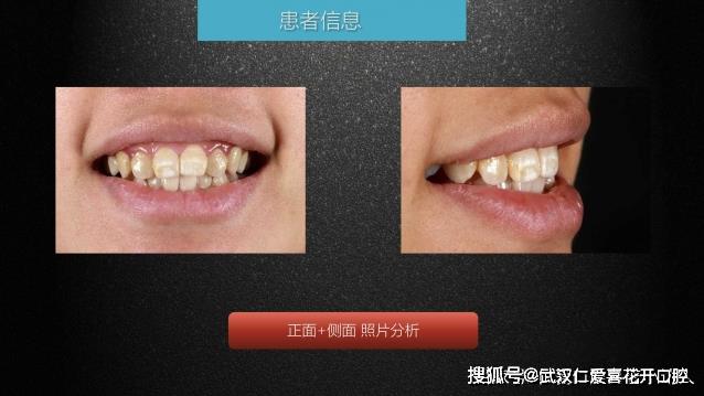 武漢仁愛口腔 數字化即刻美學貼面案例分享