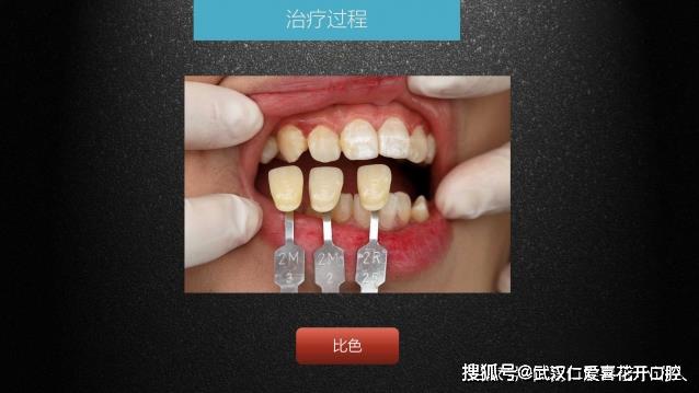 武漢仁愛口腔 數字化即刻美學貼面案例分享
