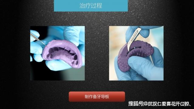 武漢仁愛口腔 數字化即刻美學貼面案例分享