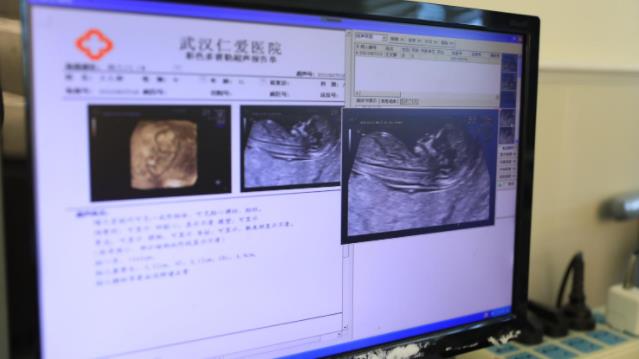 NT檢查診斷出胎兒異常,武漢仁愛產科醫生呼吁孕期產檢不能少