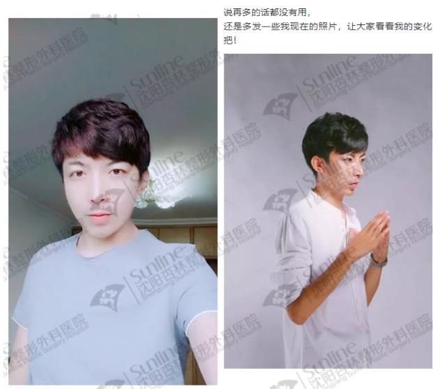 沈陽杏林整形外科醫院上下頜凸嘴矯正價格表,沈陽哪能削骨