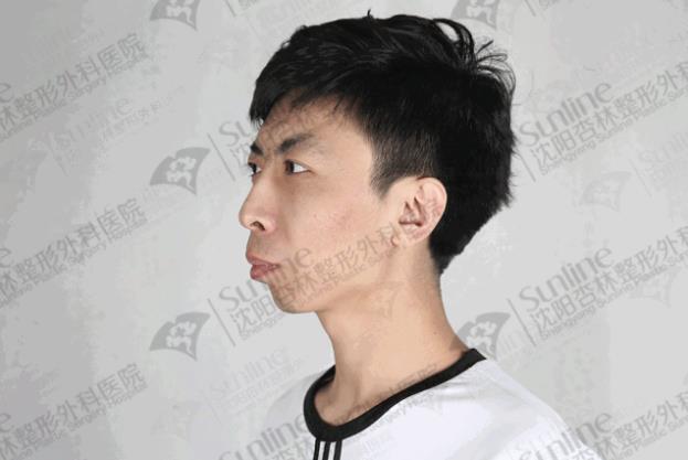 沈陽杏林整形外科醫院上下頜凸嘴矯正價格表,沈陽哪能削骨
