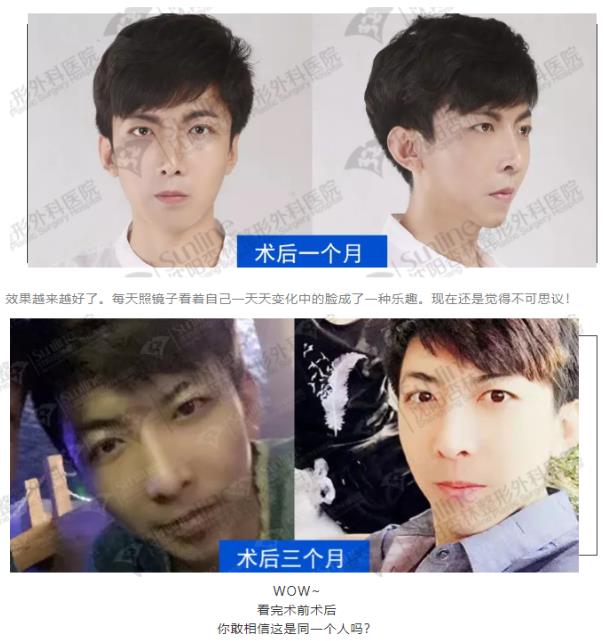 沈陽杏林整形外科醫院上下頜凸嘴矯正價格表,沈陽哪能削骨