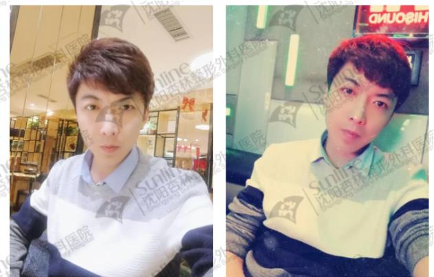 沈陽杏林整形外科醫院上下頜凸嘴矯正價格表,沈陽哪能削骨
