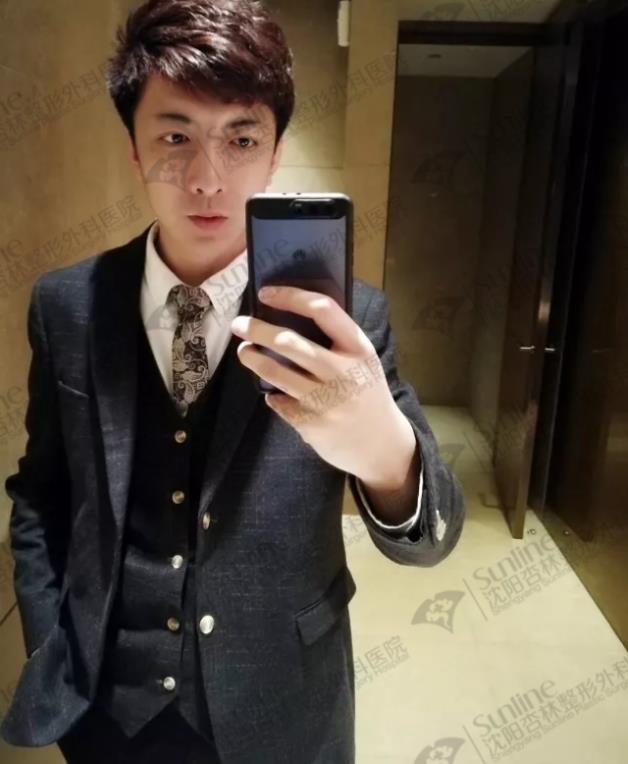 沈陽杏林整形外科醫院上下頜凸嘴矯正價格表,沈陽哪能削骨