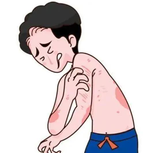 癬是怎么引起的?銀屑病人怎么看待它?