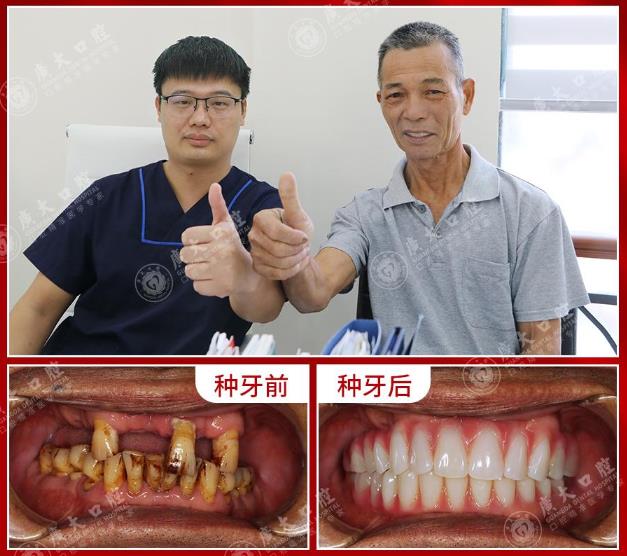 廣州種植牙醫院高齡老人也可當天種牙當天用!廣東省愛牙工程公益執種機構廣大口腔精種好牙