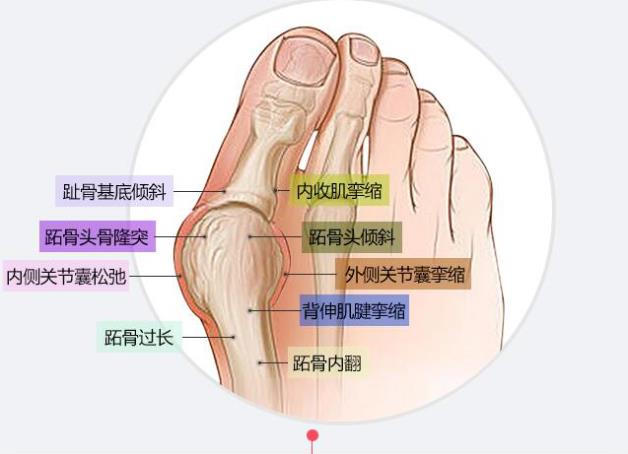 上海虹橋醫院張樹偉治療拇外翻怎么樣呢?