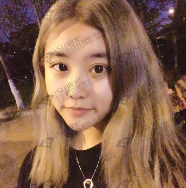 沈陽雙眼皮前后對比,雙眼皮真人實拍案例