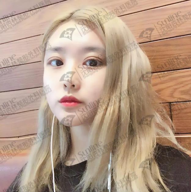 沈陽雙眼皮前后對比,雙眼皮真人實拍案例