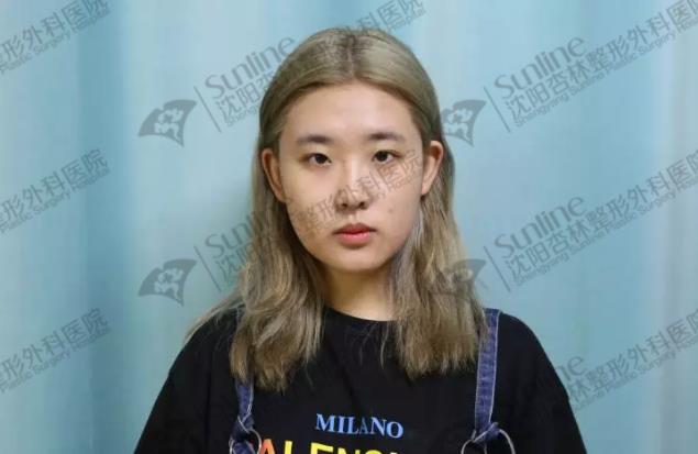 沈陽雙眼皮前后對比,雙眼皮真人實拍案例