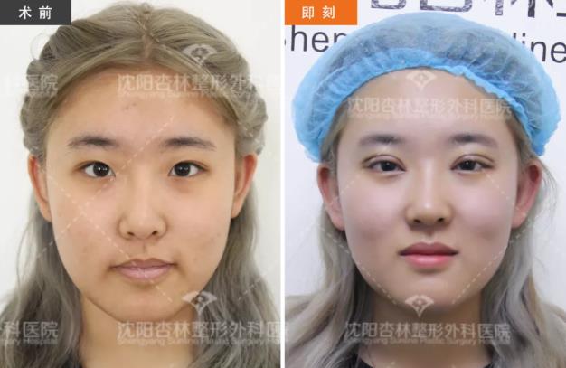 沈陽雙眼皮前后對比,雙眼皮真人實拍案例