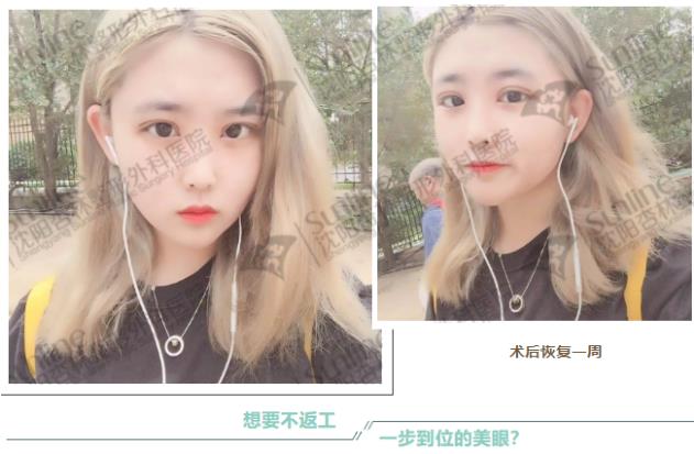 沈陽雙眼皮前后對比,雙眼皮真人實拍案例