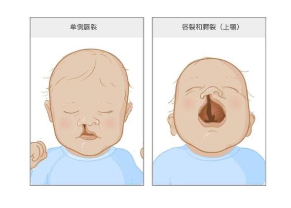 唇腭裂的圖片,導致唇腭裂的相關因素有哪些?