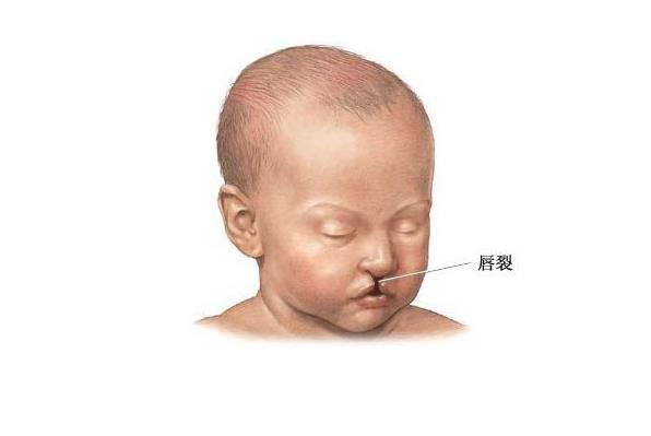 唇腭裂的圖片,導致唇腭裂的相關因素有哪些?