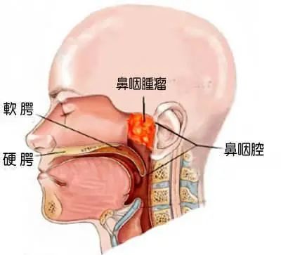 成都民生耳鼻喉醫(yī)院:涕中帶血、偏頭痛、耳鳴數(shù)月竟是鼻咽癌…