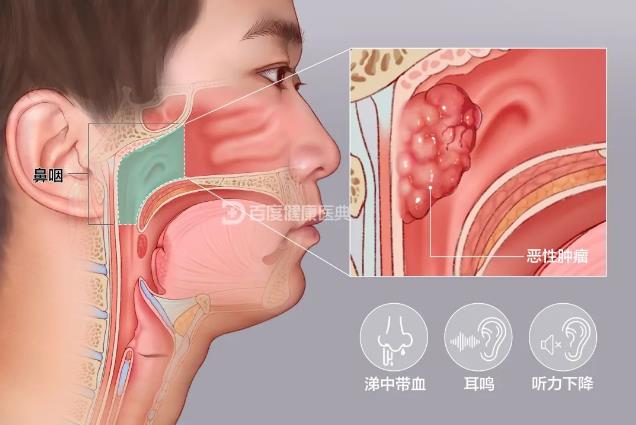 成都民生耳鼻喉醫(yī)院:涕中帶血、偏頭痛、耳鳴數(shù)月竟是鼻咽癌…