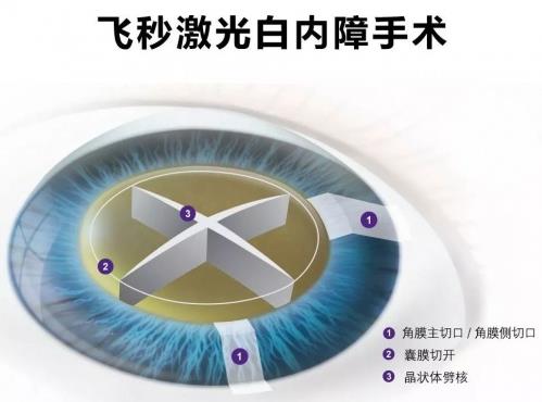 助力老年朋友暢享“睛”彩年華普瑞眼科舉辦關愛中老年眼健康公益活動