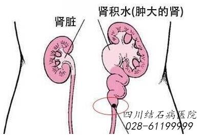 四川結(jié)石病醫(yī)院辟謠:腎結(jié)石的江湖謠言,你信了幾個(gè)?