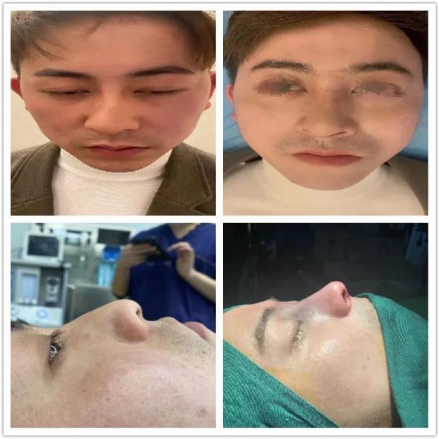 擔心隆鼻不正規?南京藝星整形美容潘峰秉承精細化整形之精髓