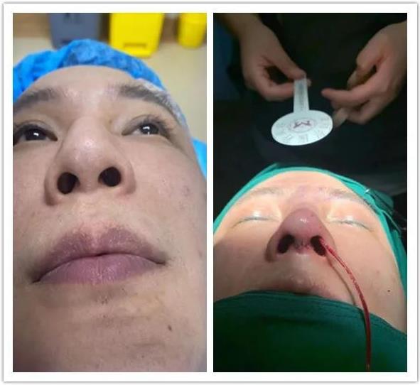 擔心隆鼻不正規?南京藝星整形美容潘峰秉承精細化整形之精髓