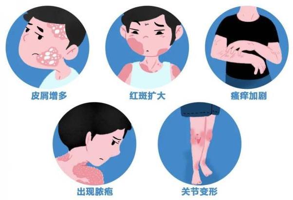醫生有話說:王喜文解密從醫20年治療銀屑病的精粹