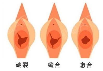 做處女膜修復的費用