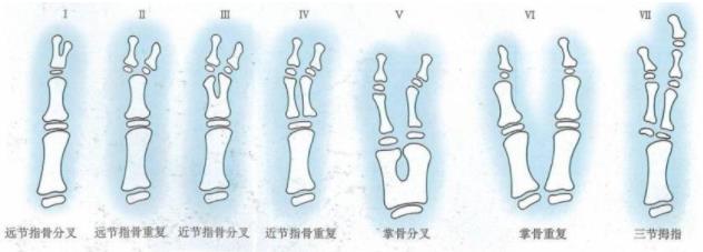 順德和平醫(yī)院手指再造還原 六指多指孩子手足畸形,過(guò)早手術(shù)有哪些好處?