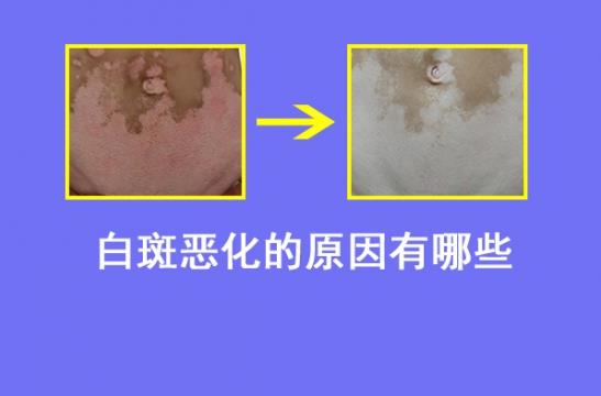 白癜風(fēng)醫(yī)生林華:導(dǎo)致白癜風(fēng)病情惡化的原因有哪些