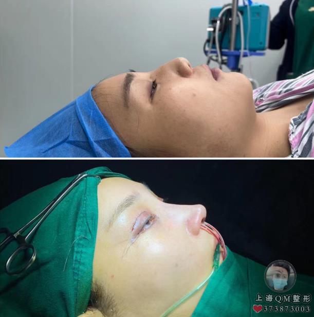上海徐麗芬整形醫生關于整形肋骨鼻的相關問答
