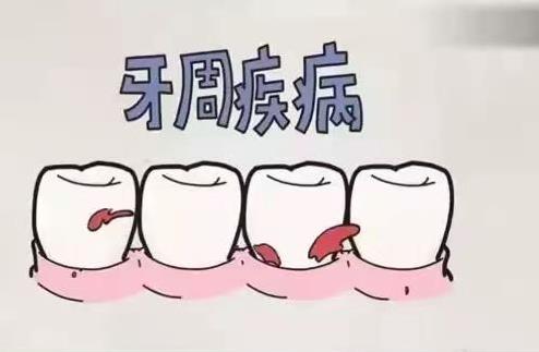 牙醫告訴你:洗牙如洗碗 真的不傷牙!
