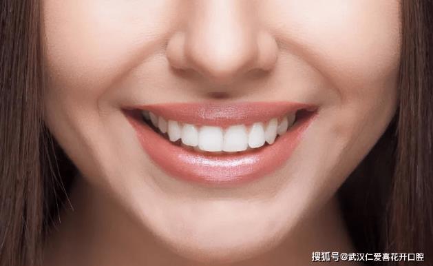 多年飽受牙黃牙丑苦惱,通過牙齒貼面——完美“蛻變”!
