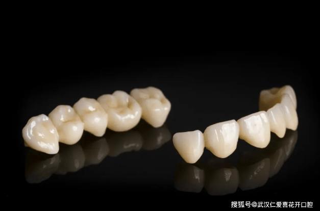 多年飽受牙黃牙丑苦惱,通過牙齒貼面——完美“蛻變”!